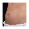 Zeltiq Fat Freezing - Coolsculpting NYC - Debra Jaliman, MD - Board Certified Dermatologist