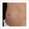 Zeltiq Fat Freezing - Coolsculpting NYC - Debra Jaliman, MD - Board Certified Dermatologist