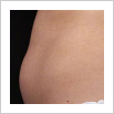 Zeltiq Fat Freezing - Coolsculpting NYC - Debra Jaliman, MD - Board Certified Dermatologist